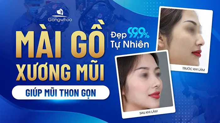 Mài Gồ Xương Mũi Giúp Mũi Thon Gọn Đẹp Tự Nhiên 99,9%