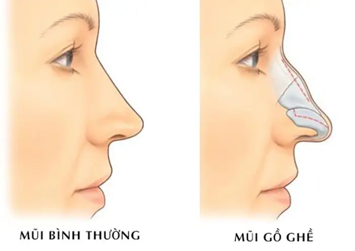 Sự khác nhau giữa mũi gồ và mũi bình thường