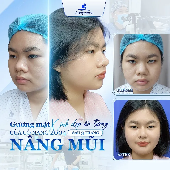 Gương mặt xinh đẹp, ưng ý sau khi nâng mũi bọc sụn tự thân tại Gangwhoo
