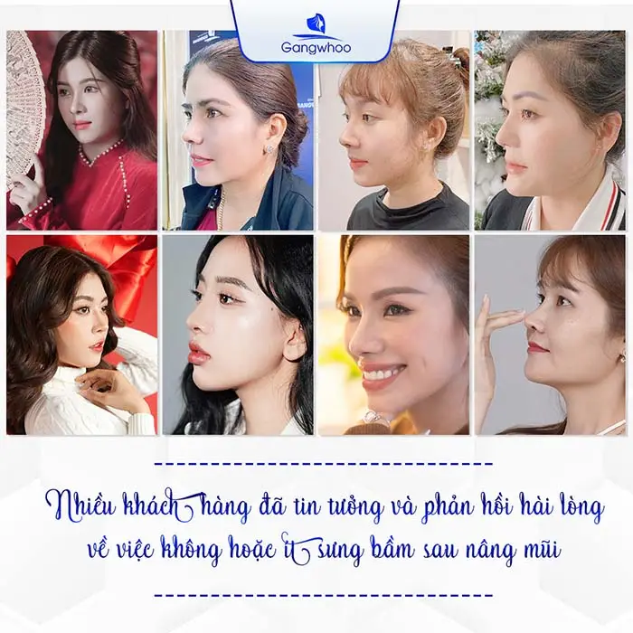 Hầu hết 99% khách hàng đều hài lòng sau khi nâng mũi tại Gangwhoo