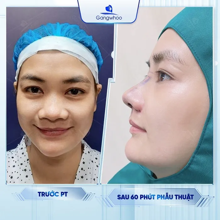 Nâng Mũi Cấu Trúc Là Gì?