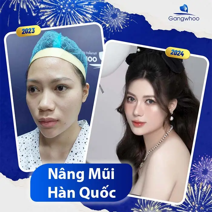 Nâng mũi Hàn Quốc Dáng Mũi Cao, Đẹp Chuẩn Như Sao “Hàn”