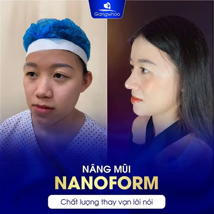 Nâng Mũi Nanoform Là Gì? Có Tốt Không?
