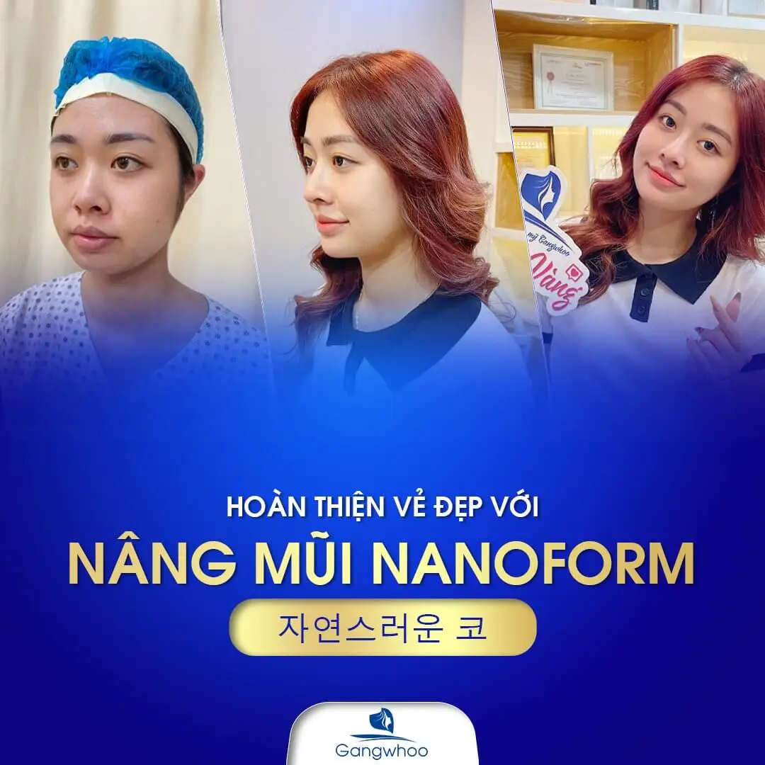 Nâng mũi Nanoform cải thiện toàn bộ các khuyết điểm của mũi cũ