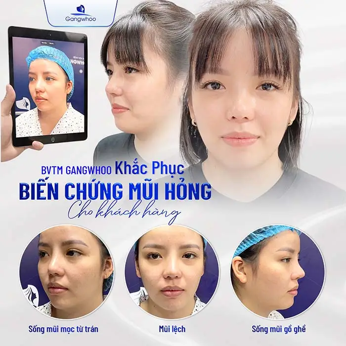 Nâng mũi sụn sườn – Giải pháp hoàn hảo cho tình trạng mũi hỏng