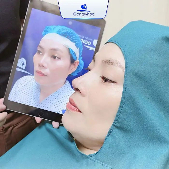 Nâng Mũi Surgiform Cho Dáng Mũi Thanh Tú Tự Nhiên