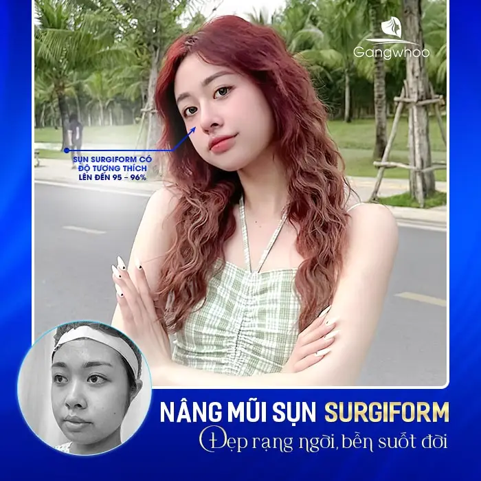 Dáng mũi hài hòa, mềm mại và đẹp tự nhiên sau khi nâng mũi Surgiform