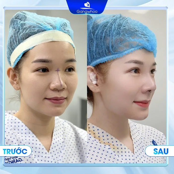 Sở hữu dáng mũi ưng ý chỉ sau 60 phút thực hiện tại Gangwhoo