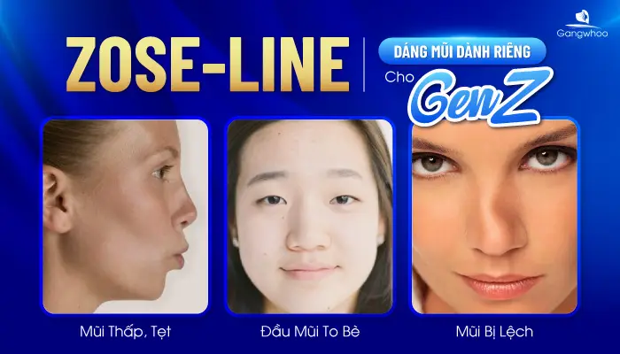 Nâng mũi Zose – Line, phương pháp nâng mũi dành riêng cho Gen Z