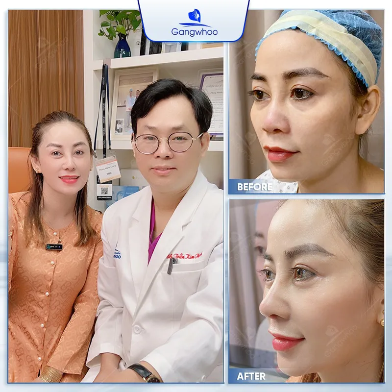 TMV Gangwhoo đã thực hiện nhiều ca nâng mũi ưng ý cho khách hàng