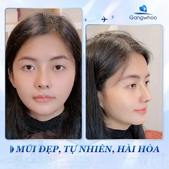 Mũi đẹp tự nhiên, hài hòa sau khi sửa mũi hỏng