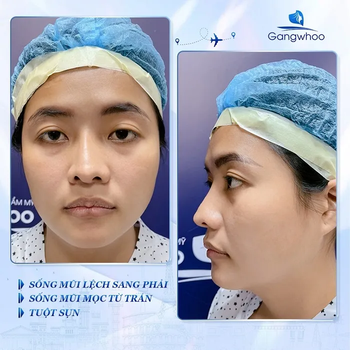 Nguyên nhân dẫn đến sửa mũi hỏng sau phẫu thuật