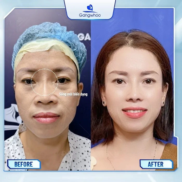 Mũi lệch sống khiến khuôn mặt bị mất cân đối