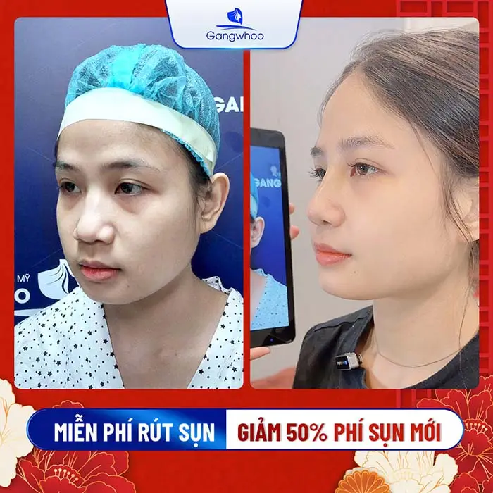 Gangwhoo hỗ trợ 100% chi phí rút sụn mũi cũ