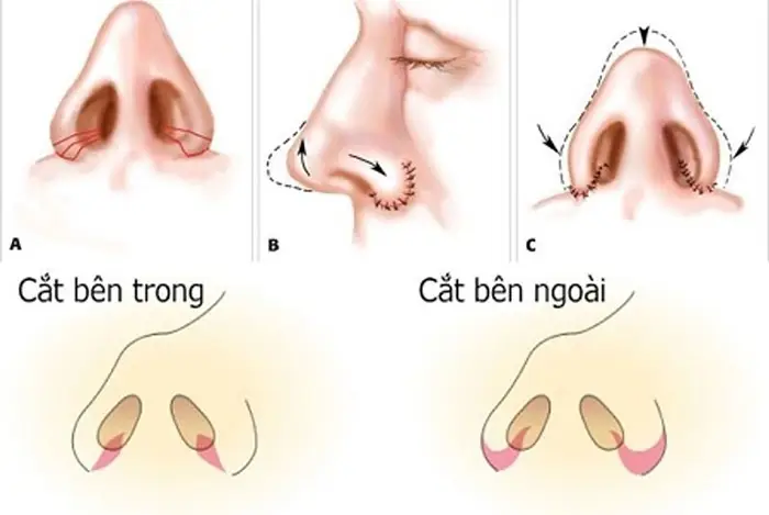 2 kỹ thuật thu nhỏ cánh mũi phổ biến hiện nay