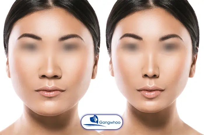 Thu Gọn Cánh Mũi Là Gì? 2 Kỹ Thuật Thu Gọn Cánh Mũi Phổ Biến