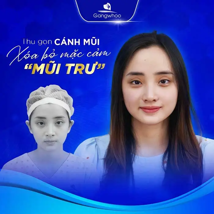 Gương mặt thanh tú sau khi thực hiện thu gọn cánh mũi