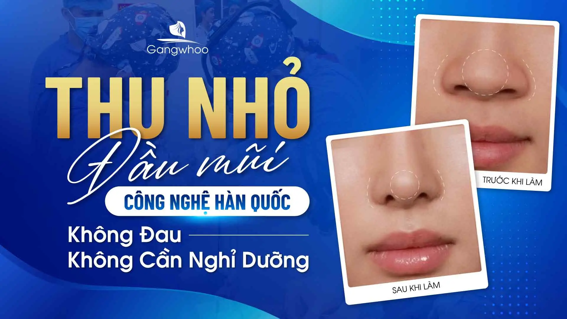 Thu Nhỏ Đầu Mũi Công Nghệ Hàn Quốc: Không Đau – Không Cần Nghỉ Dưỡng
