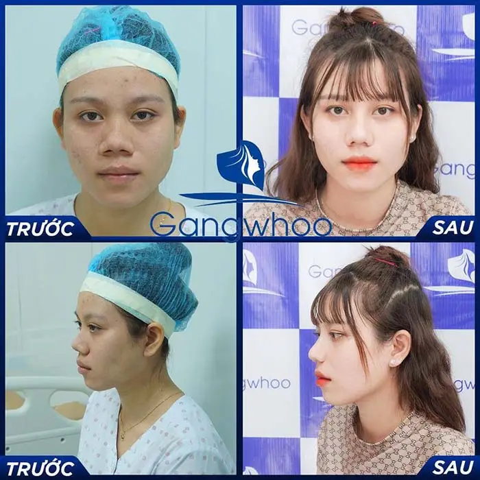 Thu nhỏ đầu mũi giúp khuôn mặt trở nên duyên dáng hơn